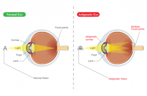 hiperopie miopia astigmatism