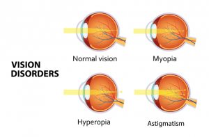 astigmatism miopic Miopie sau astigmatism