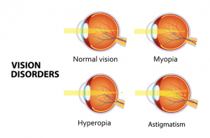 refractive error (myopia hyperopia astigmatism)