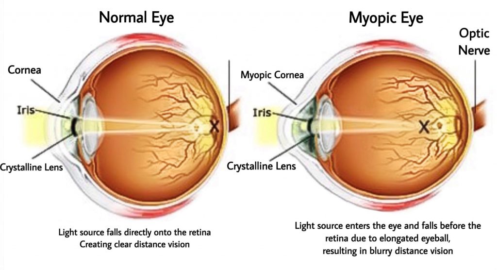 myopia-control-in-singapore