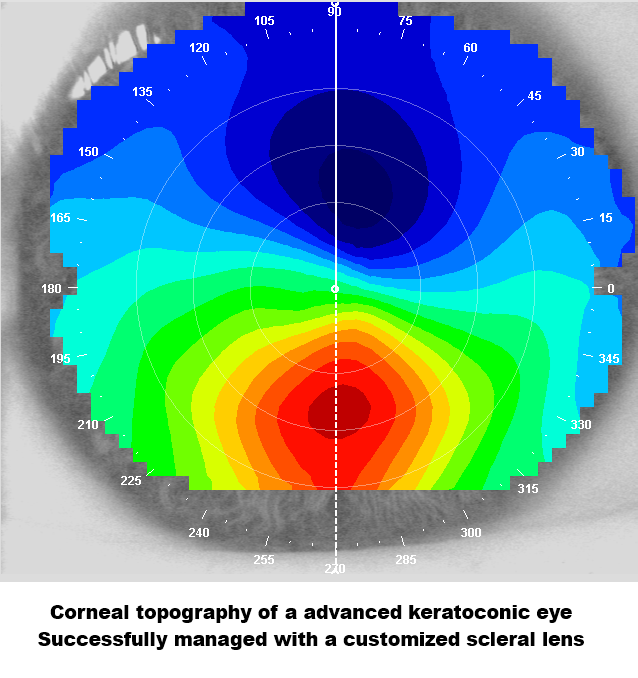 Color-coded corneal topography map of an advanced keratoconic eye; central red area with cooler blue outer zones, showing scleral lens management.