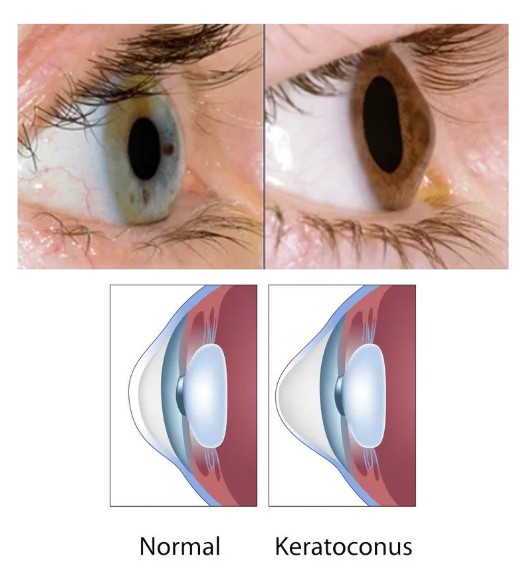 Close-up of two eyes (blue left, brown right) with accompanying cornea diagrams comparing normal vs. keratoconus anatomy.